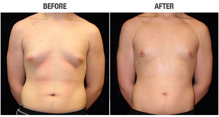 Male Breast Reduction In Noida